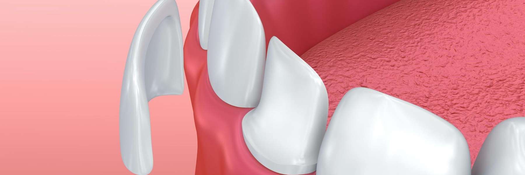Keep Your Veneers Looking Great
