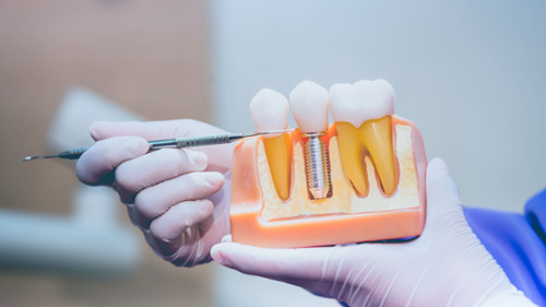 Dentist holding a cross-section dental implant model showing titanium post in jawbone model