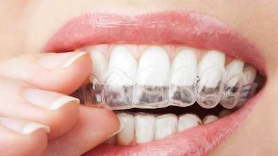 invisible braces in mona vale 