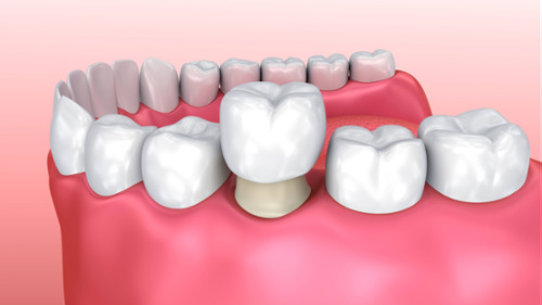 3D dental illustration showing a porcelain crown being placed over a prepared tooth in the lower jaw