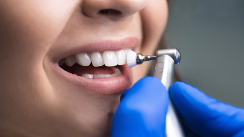 Dentist using a polishing handpiece to clean a patient's teeth during a professional dental clean
