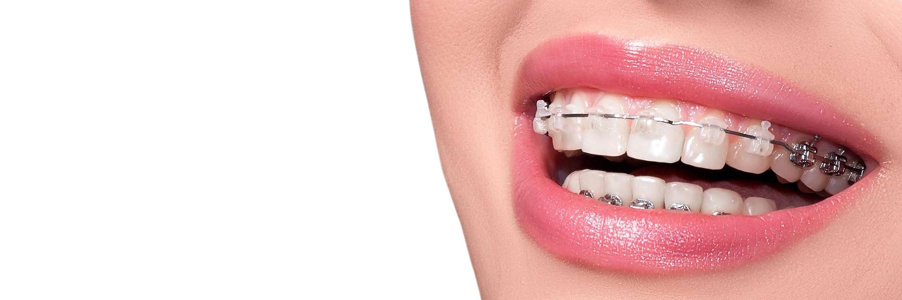 teeth whitening mona vale