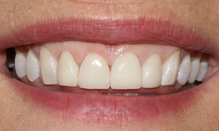 Anterior Veneers Mona Vale After
