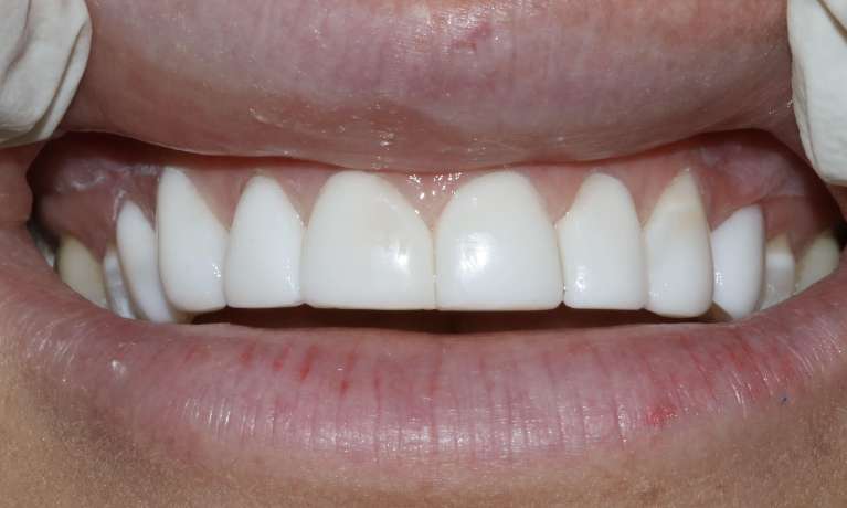 Composite Veneers Mona Vale After
