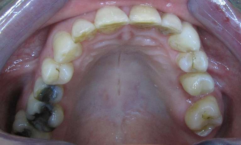 Alignment-of-displaced-premolar-After-Image