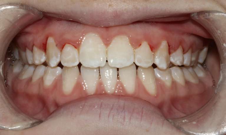 Braces-on-Upper-Teeth-After-Image