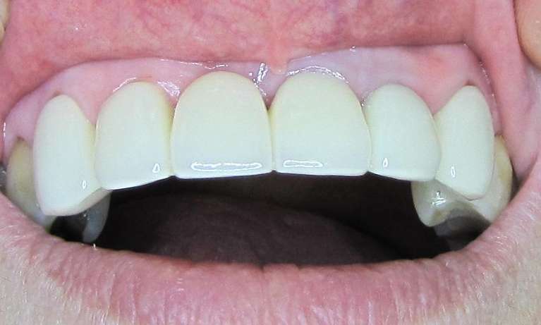 Bridge-Replacement-After-Image