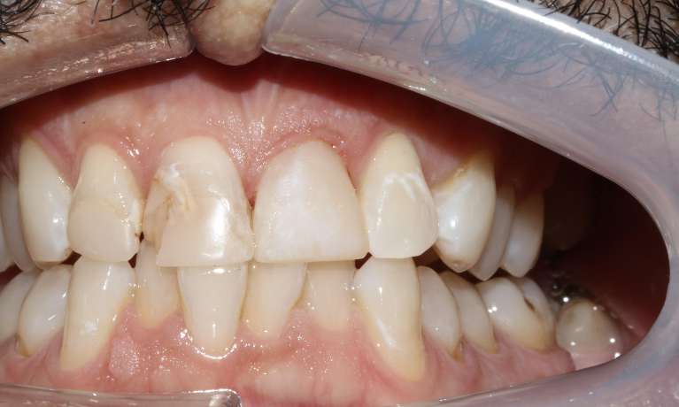 Broken-Front-Tooth-After-Image
