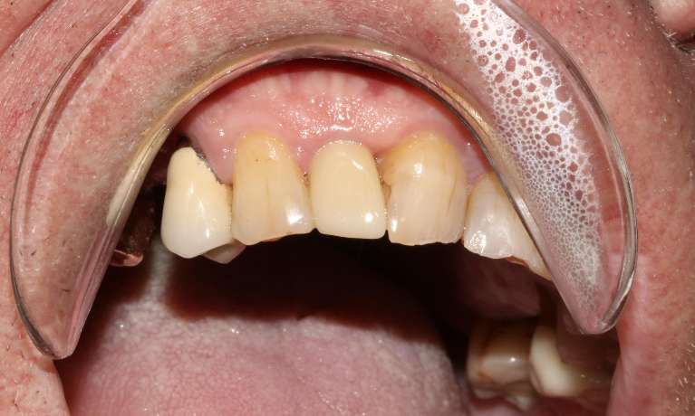 Broken-Lateral-Incisor-After-Image