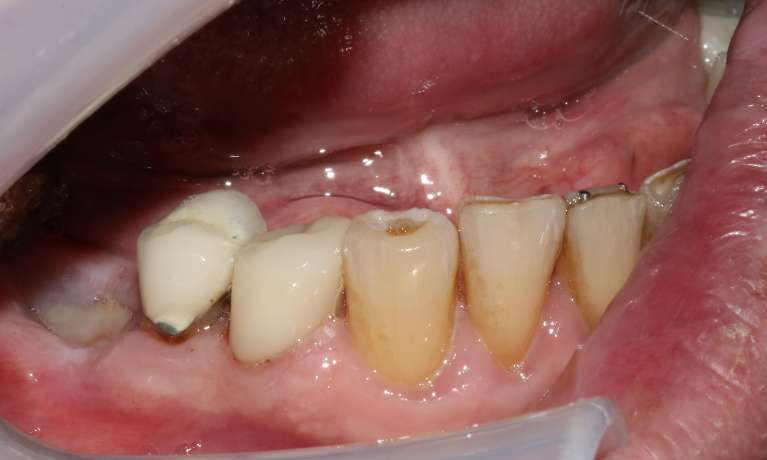 Close-up of the same patient's lower teeth after the broken tooth was restored with a post, core buildup, and a dental crown.