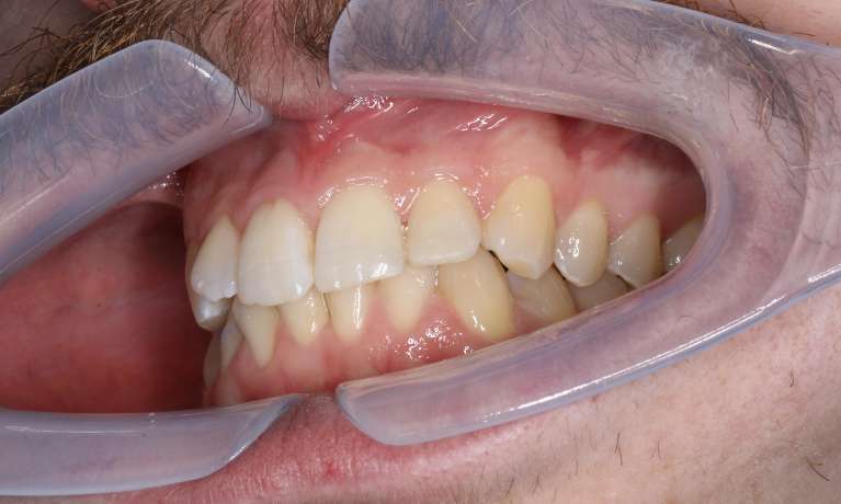 repaired chipped tooth in mona vale nsw