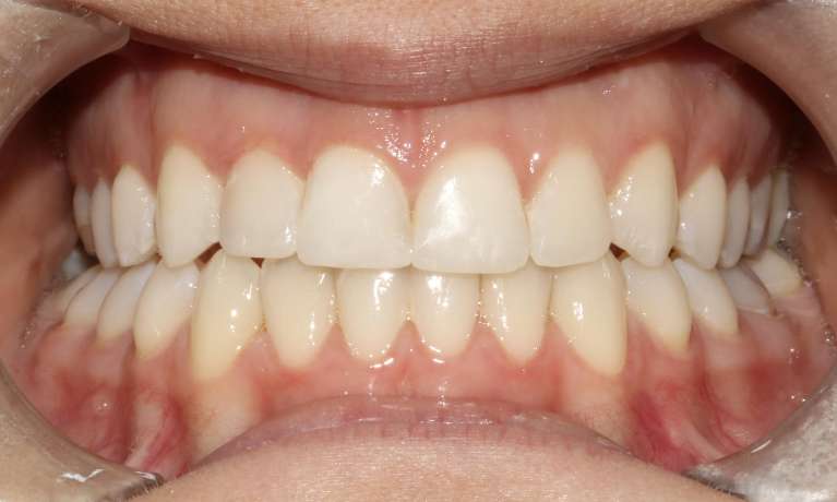 Clear-Aligners-After-Image