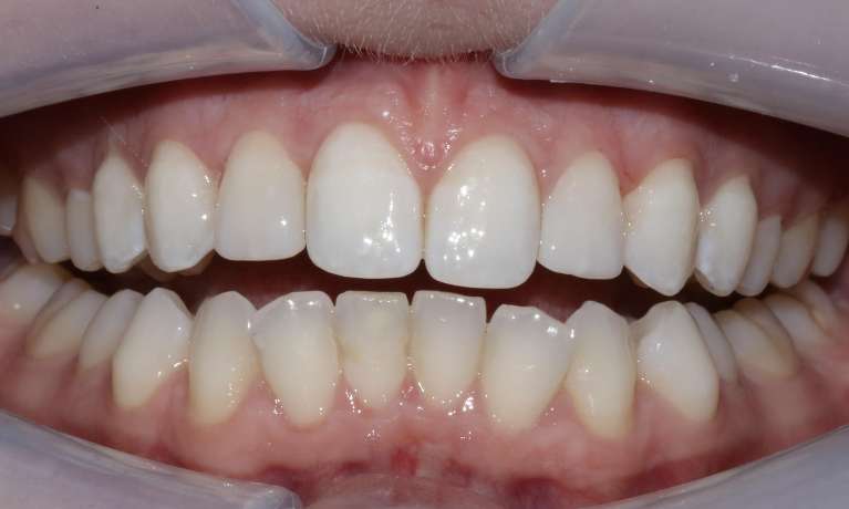 Close-up of the same patient's upper teeth after composite restoration, with peg laterals reshaped to match the surrounding teeth.
