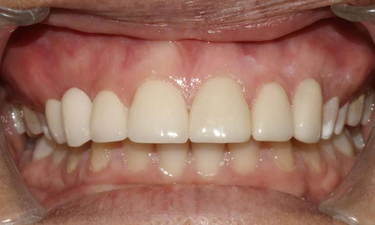 Crown Porcelain Veneer Bridge NSW Dental After