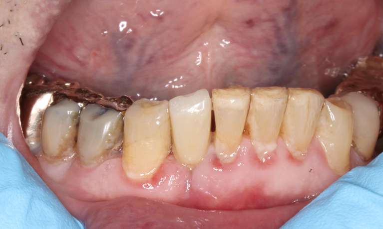 Close-up of the same person's lower teeth after dental treatment, with improved alignment and restoration.