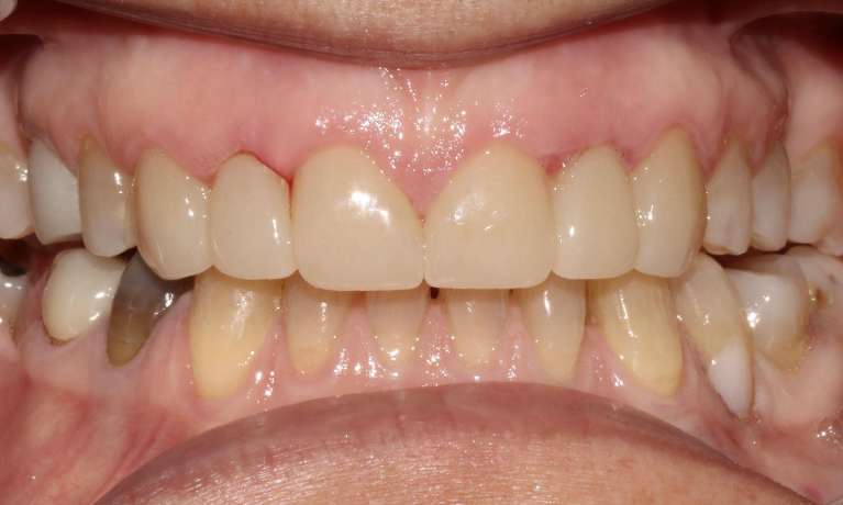 Invisalign-and-Fixed-Bridge-to-Complete-After-Image
