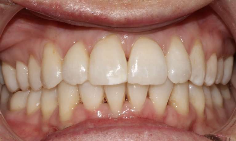 Invisalign Mona Vale After