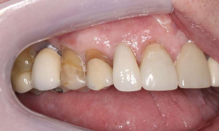 Close-up of the same patient's upper teeth after receiving porcelain crowns, restoring shape and function.