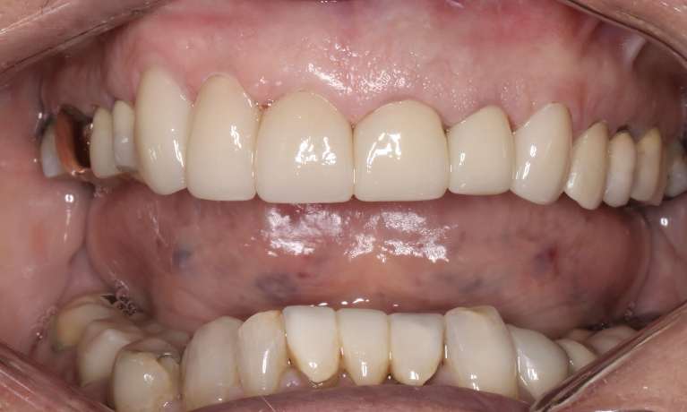 Close-up of the same patient's teeth after receiving six porcelain crowns, with improved alignment and aesthetics.