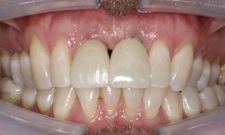 Close-up of the same patient's upper teeth after a single dental implant was placed, restoring the natural look of their smile.