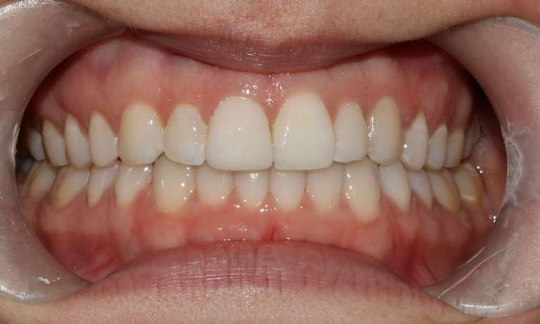 Straight-Smile-with-Invisalign-After-Image
