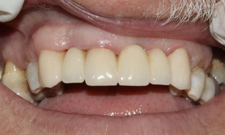 Restoration upper anterior with crowns and bridge after