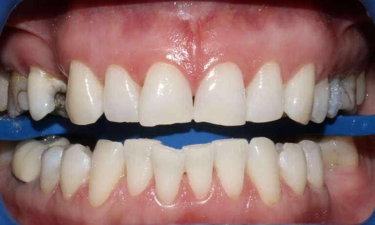 Zoom whitening Mona Vale After