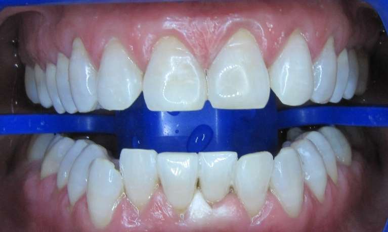 Zoom Teeth Whitening BMB Dental After 1