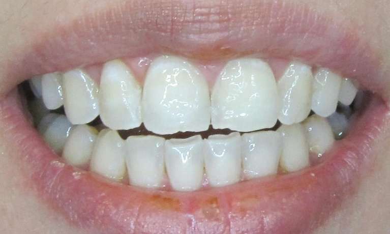Zoom Teeth Whitening BMB Dental After 2
