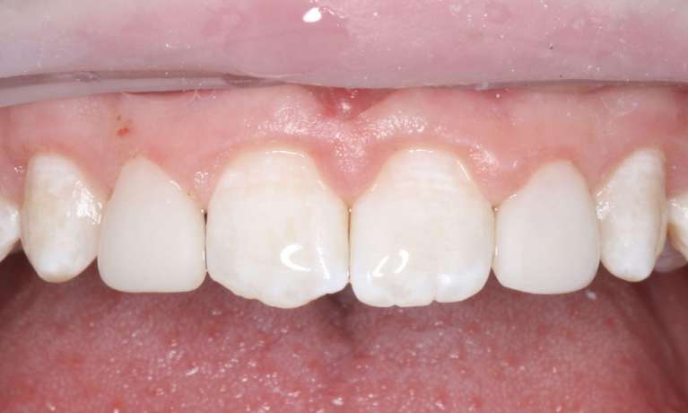 Close-up of the same patient's upper teeth after direct composite restoration, with peg laterals reshaped to match surrounding teeth.