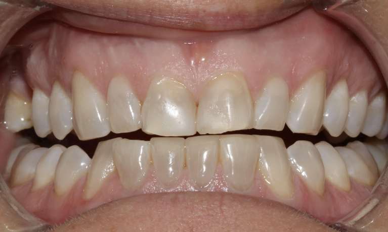Anterior Veneers Mona Vale Before