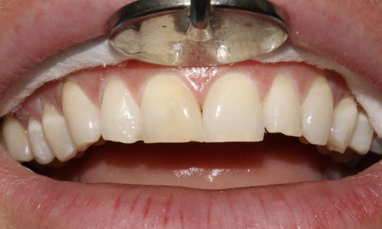 Composite Veneers Mona Vale Before