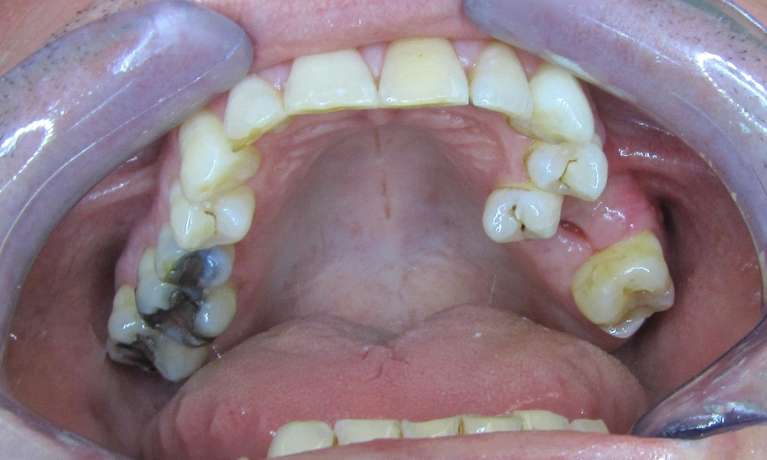 Alignment-of-displaced-premolar-Before-Image