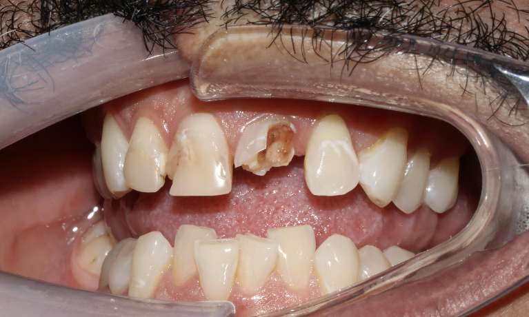 Broken-Front-Tooth-Before-Image