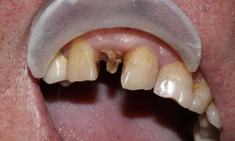 Broken-Lateral-Incisor-Before-Image