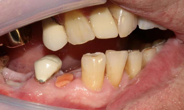 Close-up of a patient's lower teeth showing a broken tooth down to the gum line before restoration.