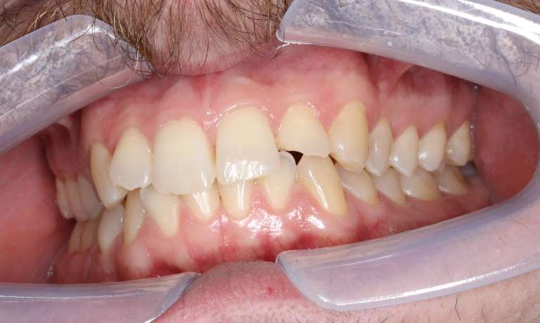 chipped tooth before restoration in mona vale