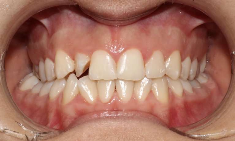 Clear-Aligners-Before-Image