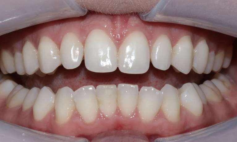 Close-up of a patient's upper teeth showing small peg laterals before composite restoration.