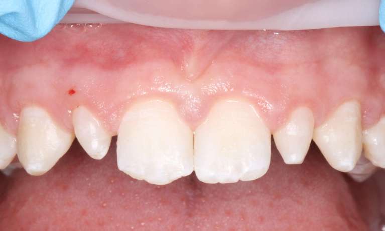 Close-up of a patient's upper teeth showing peg laterals with smaller, uneven shapes before composite restoration.
