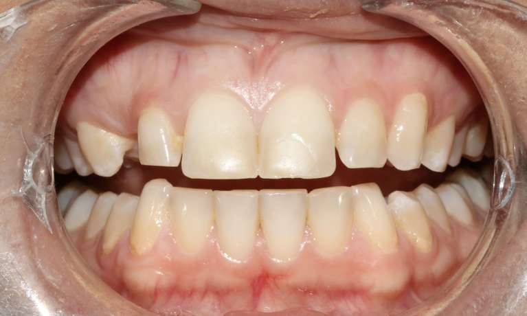 Crown Porcelain Veneer Bridge NSW Dental Before