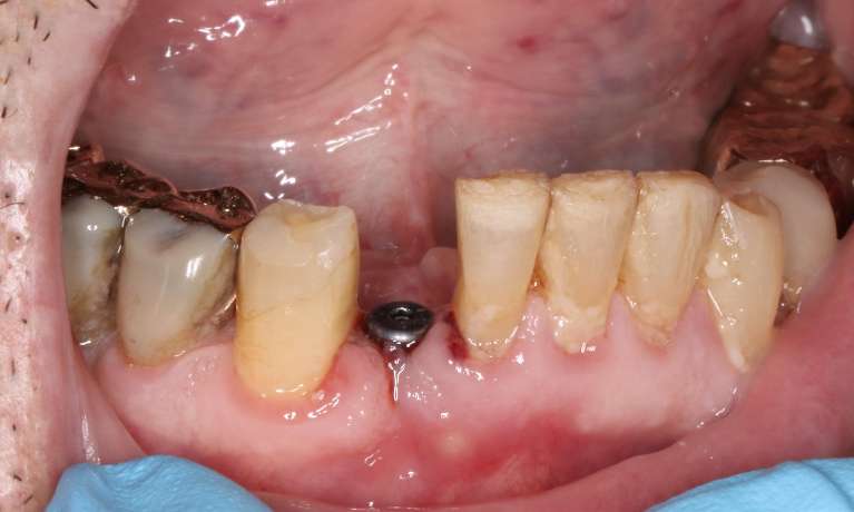 Close-up of a person's lower teeth before dental treatment, showing damaged and missing teeth.