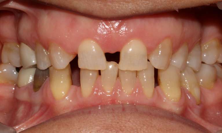 Invisalign-and-Fixed-Bridge-to-Complete-Before-Image