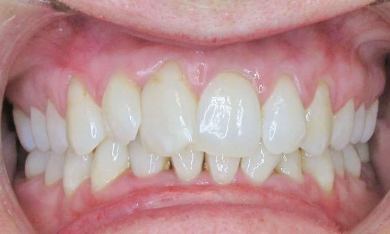 Invisalign Mona Vale Before