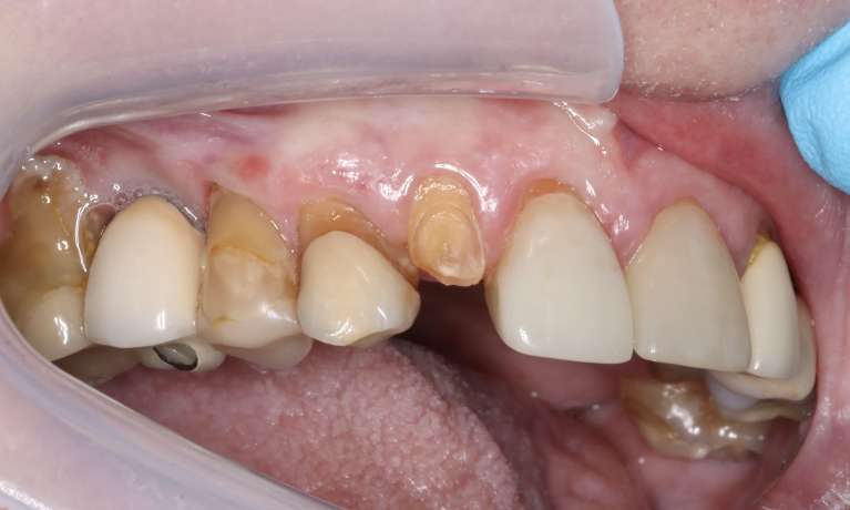 Close-up of a patient's upper teeth before treatment, showing damaged and missing teeth.