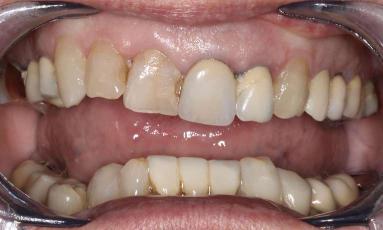 Close-up of a patient's teeth before treatment, showing uneven alignment and discoloration.