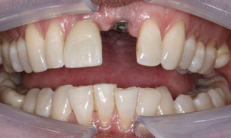 Close-up of a patient's upper teeth showing a missing front tooth before receiving a dental implant.