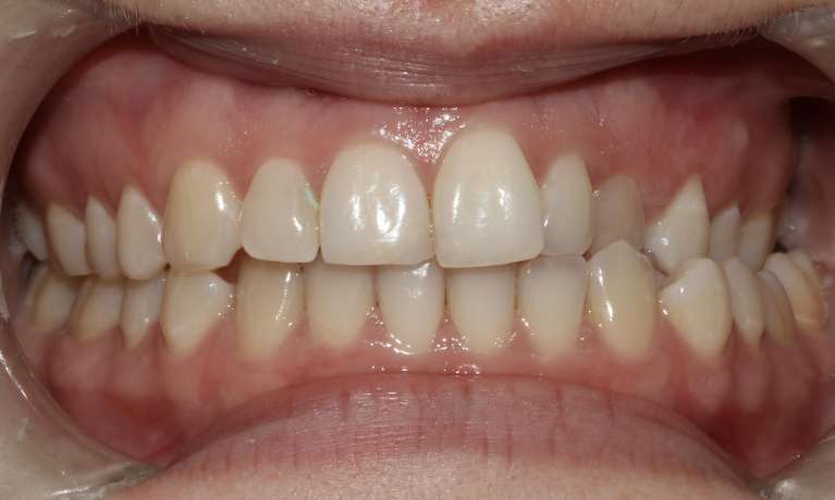 Straight-Smile-with-Invisalign-Before-Image