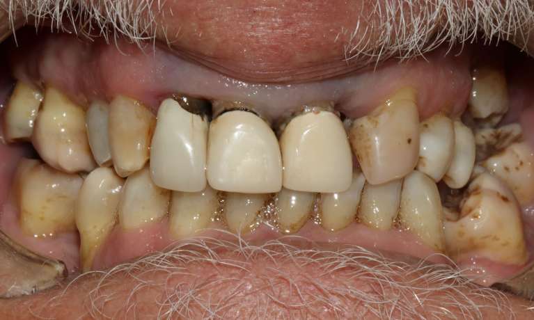 Restoration upper anterior with crowns and bridge before
