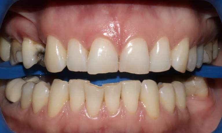Zoom whitening Mona Vale Before